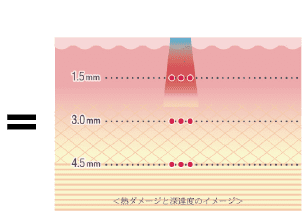 ウルセラ + 光・レーザー治療