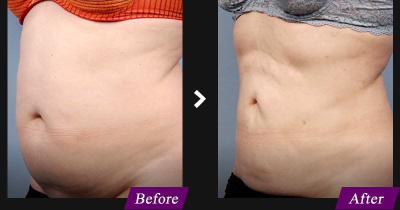 エンブレイスRF(フェイスタイト/ボディタイト) 腹部の症例写真 before after
