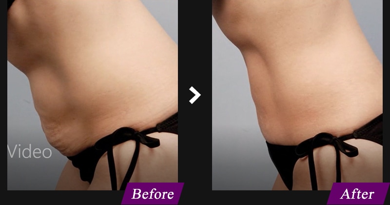 エンブレイスRF(フェイスタイト/ボディタイト) 腹部の症例写真 before after