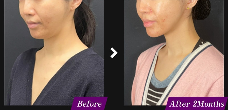 エンブレイスRF(フェイスタイト/ボディタイト) アゴ下の症例写真 before after