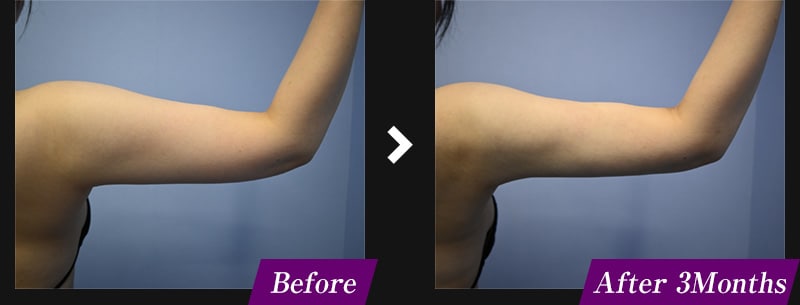 エンブレイスRF(フェイスタイト/ボディタイト) 二の腕の症例写真 before after