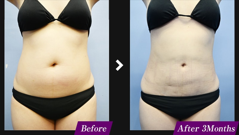 エンブレイスRF(フェイスタイト/ボディタイト) 腹部の症例写真 before after