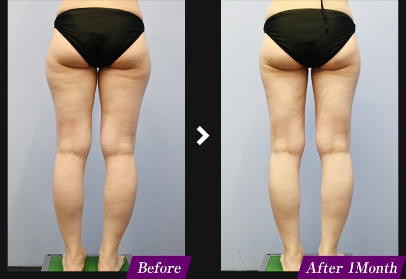 エンブレイスRF(フェイスタイト/ボディタイト) 腹部の症例写真 before after