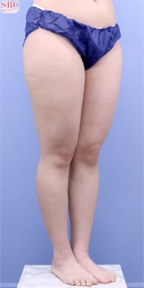 下半身の脂肪吸引　症例写真　ビフォー