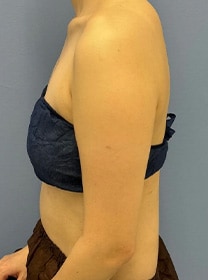 二の腕の脂肪吸引　症例写真　ビフォー
