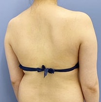 背中の脂肪吸引　症例写真　ビフォー