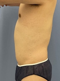 お腹の脂肪吸引　症例写真　アフター