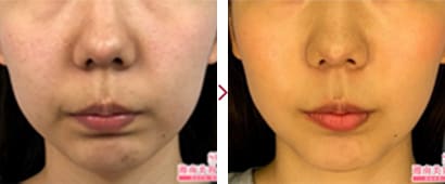 顔(ホホ・アゴ下+エラ下)美ボディ脂肪吸引症例1