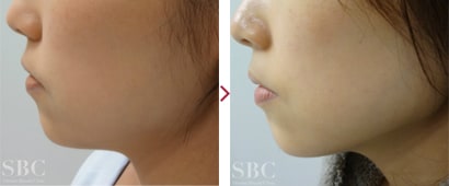 顔(ホホ・アゴ下+エラ下)美ボディ脂肪吸引症例2
