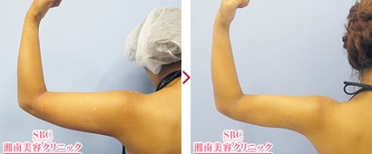 二の腕美ボディ脂肪吸引症例1