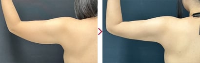 二の腕美ボディ脂肪吸引症例2