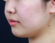 新・脂肪溶解リニアハイフ 症例写真 術前