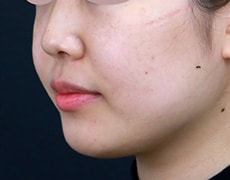 新・脂肪溶解リニアハイフ 症例写真 3回目の施術から1ヶ月後