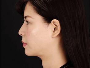 クールスカルプティング&reg; エリート（クルスカダブル） 症例写真 1回目の施術から17週間後