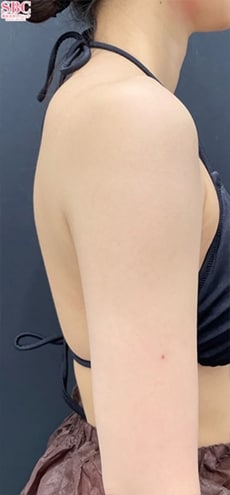 1Week After