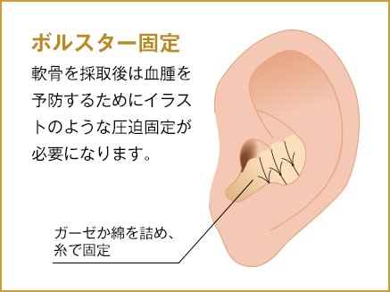 ボルスター固定