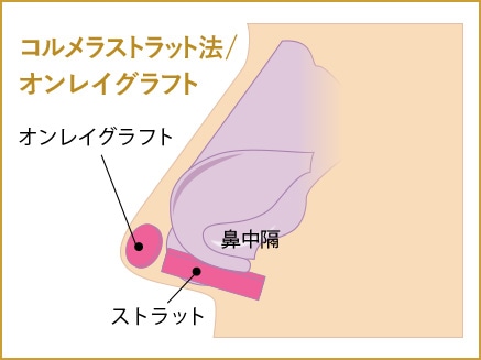 コルメラストラット法/オンレイグラフト