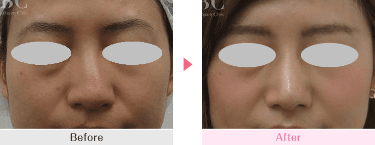 斜鼻修正術の症例写真 施術前 施術後 No.105520