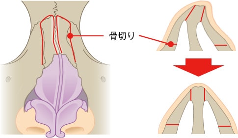 施術方法（骨切部位）