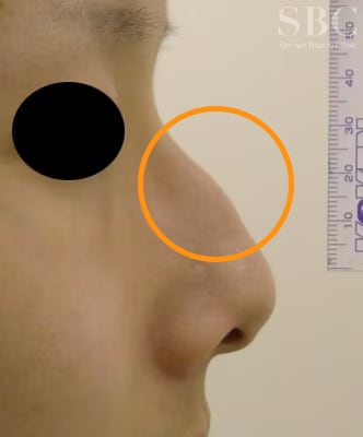 そもそもワシ鼻とは