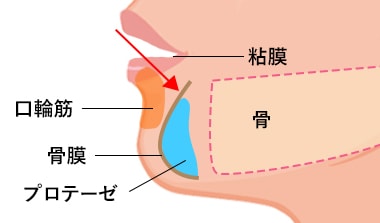 アゴプロテーゼの施術方法