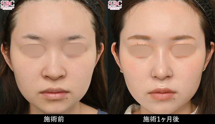 鼻フルプラン症例写真