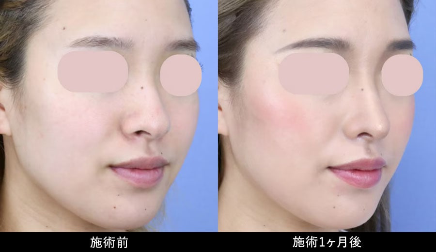 鼻フルプラン症例写真