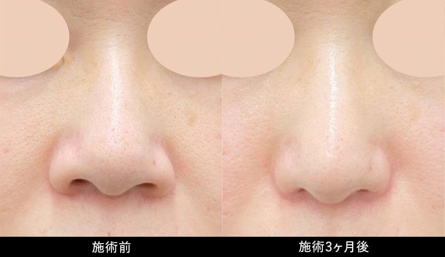 鼻フルプラン症例写真