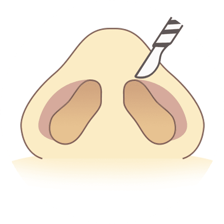 鼻孔縁を切除