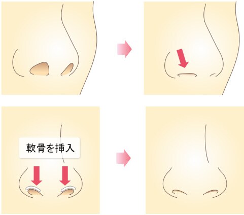 鼻孔縁下降術の施術内容