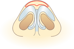②鼻尖軟骨周辺の脂肪が多い場合は取り除きます。