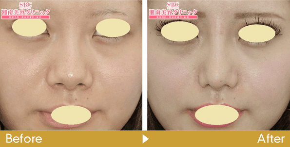 小鼻縮小術(鼻翼縮小)の症例写真No.197362