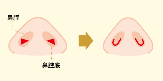 鼻腔内切開