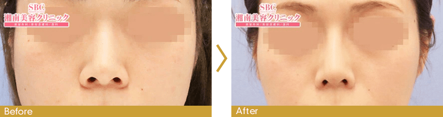 小鼻縮小術(鼻翼縮小)ピックアップ症例