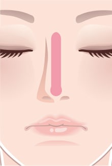 プロテーゼ挿入