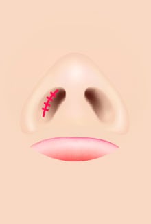縫合