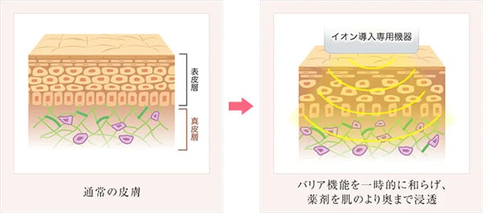 イオン導入の仕組み