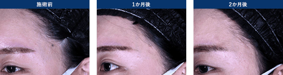 CO2レーザー 施術前 施術後