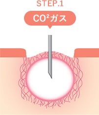 トライフィルプロの仕組み STEP2