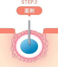 トライフィルプロの仕組み STEP3