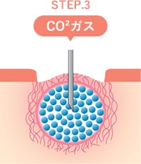トライフィルプロの仕組み STEP4