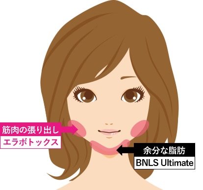 エラボトックス+脂肪溶解注射 BNLS アルティメット(小顔注射)