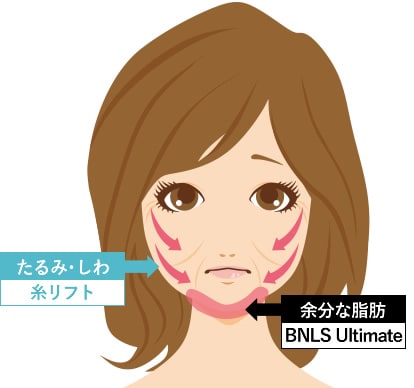 糸リフト+脂肪溶解注射 BNLS アルティメット(小顔注射)