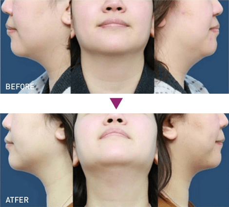 脂肪溶解注射 BNLS アルティメット(小顔注射)の症例写真2 ビフォーアフター