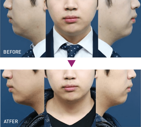 脂肪溶解注射 BNLS アルティメット(小顔注射)の症例写真3 ビフォーアフター