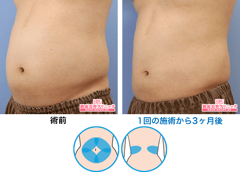 症例写真13 土屋さん(腹部4＋腰2エリア）1回の施術から3ヶ月後