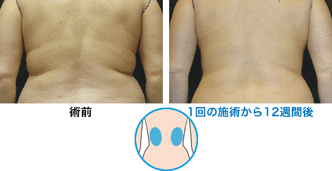 症例写真2 腰 1回の施術から12週間後