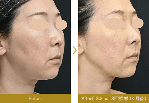 180shotのBeforeAfter画像