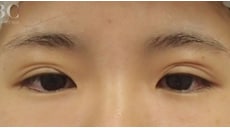 二重整形（他院修正）　症例写真　ビフォー③