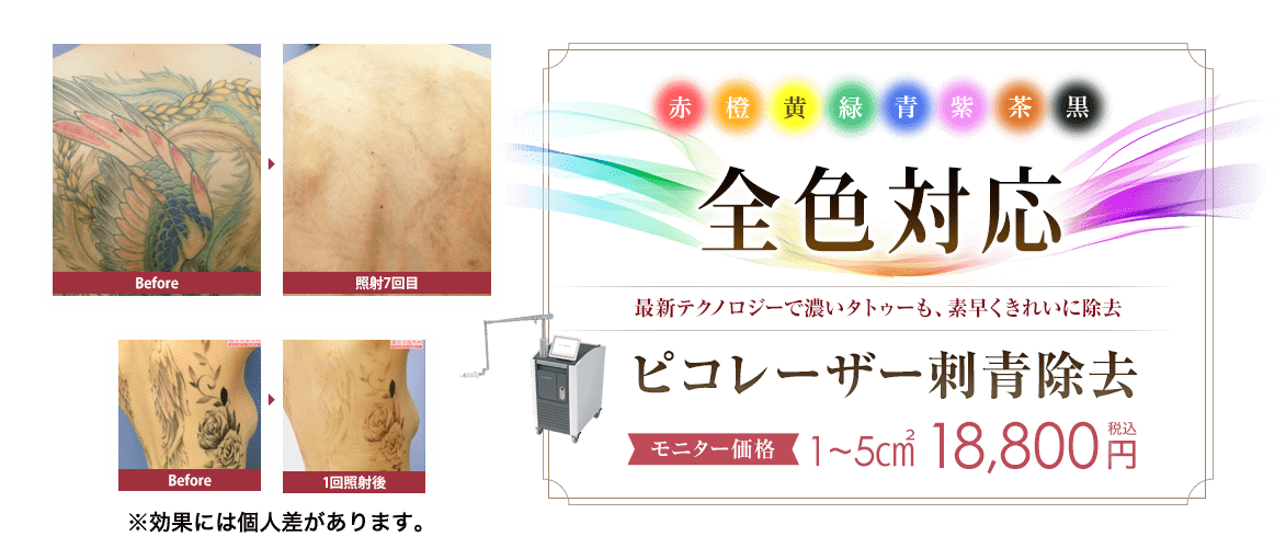 ピコレーザー刺青除去(エンライトンⅢ/エンライトンSR/PQXピコレーザー)